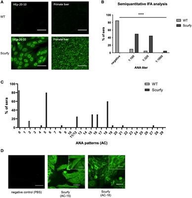 Regulatory T-cell deficiency leads to features of autoimmune liver disease overlap syndrome in scurfy mice